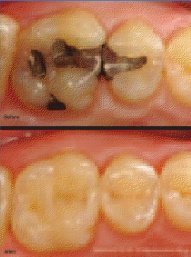 Restauração antiga em comparação com aquela que utiliza a nanotecnologia.